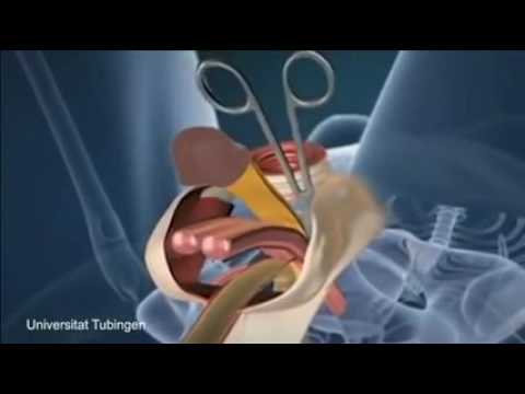 Các bác sĩ phẫu thuật chuyển giới từ nam sang nữ ra sao