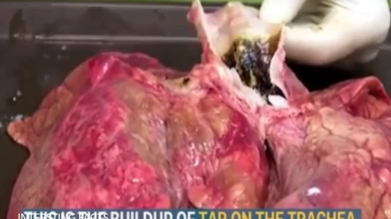 Lá phổi đen kịt sau khi hút 20 điếu thuốc lá