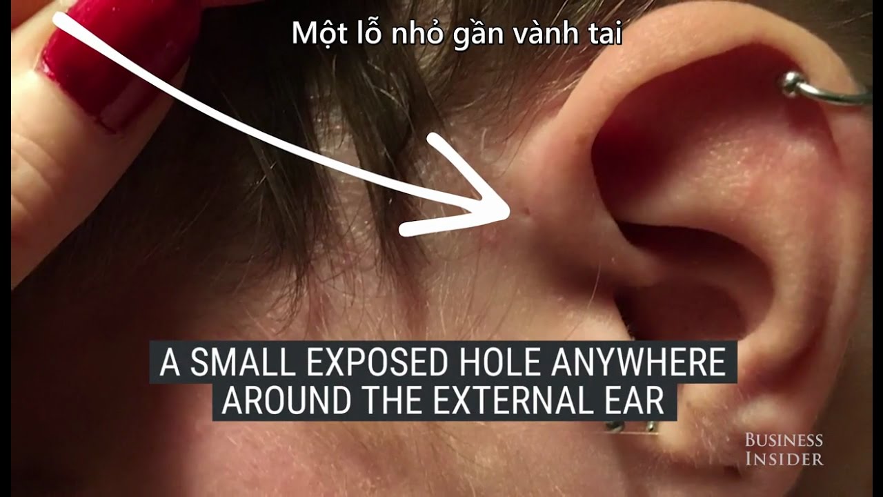 Tại sao một số người có lỗ nhỏ ở vành tai