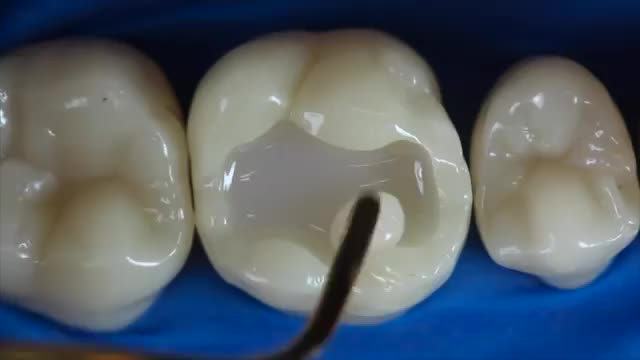 Everyone got mesmerized seeing this dentist artist working on a dental restoration