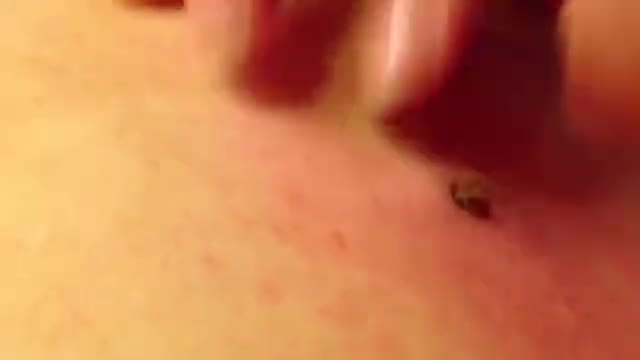 Nặn cục mụn có "tuổi thọ" 20 năm 