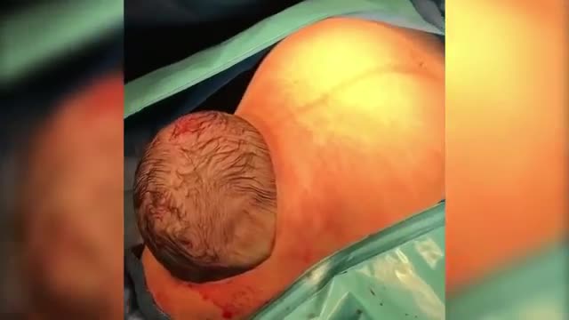 Em bé tự chui đầu ra khỏi bụng mẹ