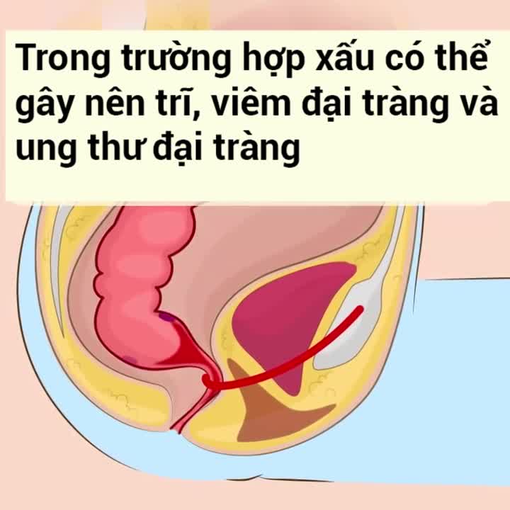 Rất nhiều người đang đi vệ sinh sai cách 