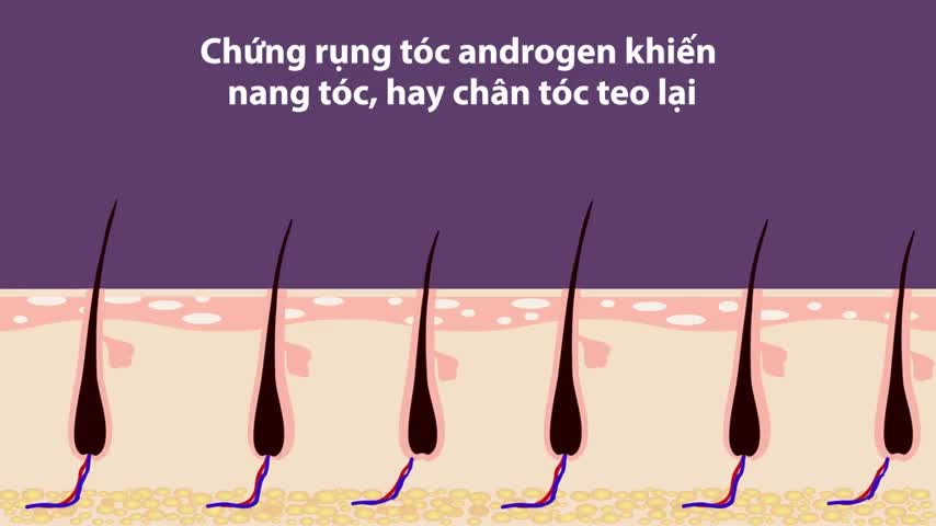 Thủ phạm gây ra chứng rụng tóc