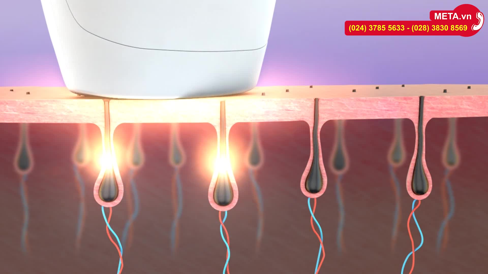 Nguyên lý triệt lông bằng công nghệ xung ánh sáng