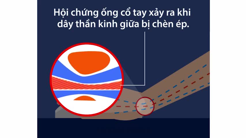Cách đặt tay đúng khi làm việc với máy tính